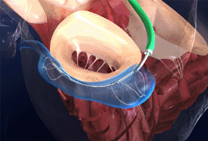 Image: The enhanced Carillon Mitral Contour System in situ (Photo courtesy of Cardiac Dimensions).